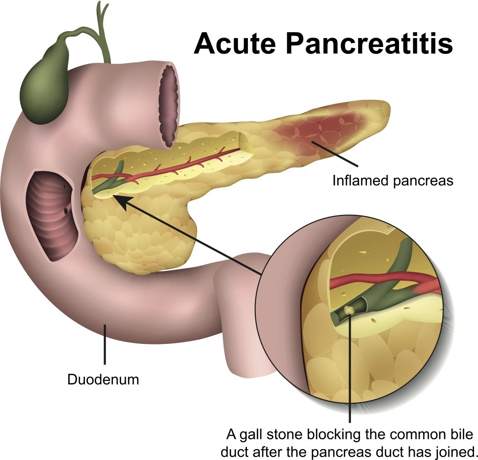 Acute Pancreatitis