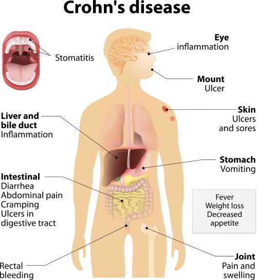 CD Crohn's Disease