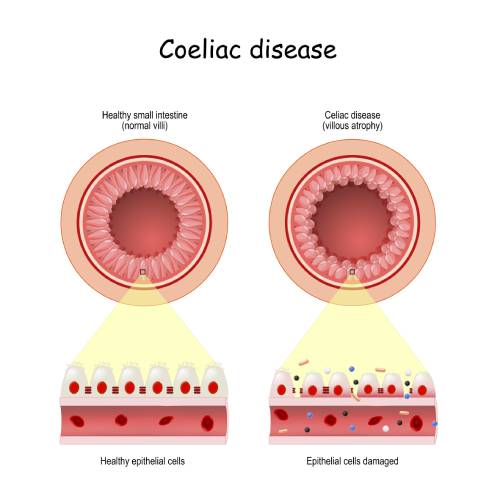 Coeliac Disease