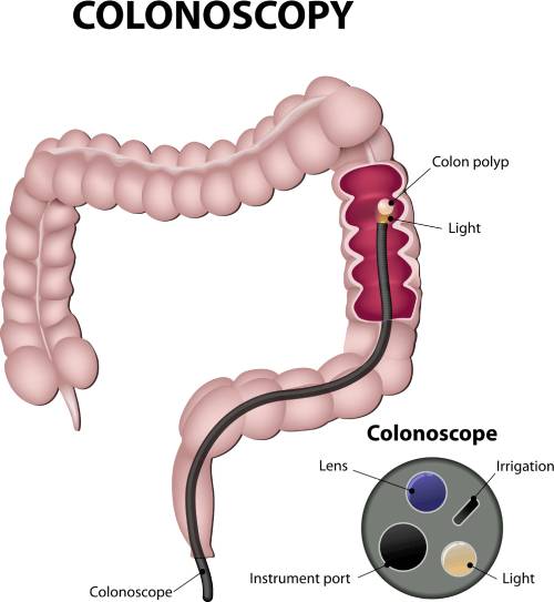 Colonoscopy