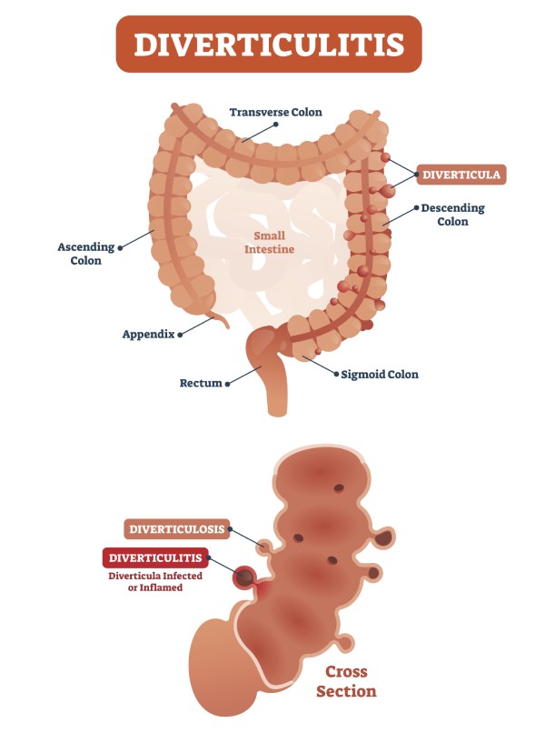 Diverticulosis / Diverticulitis - Gastro IQ