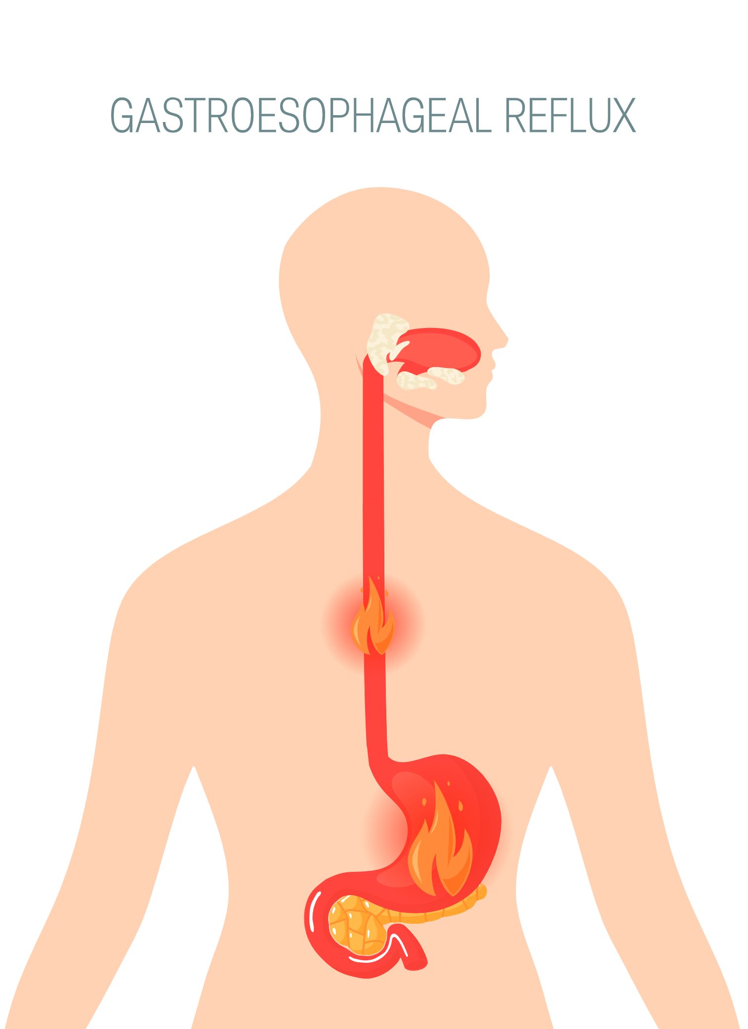 Gastroesophageal Reflux