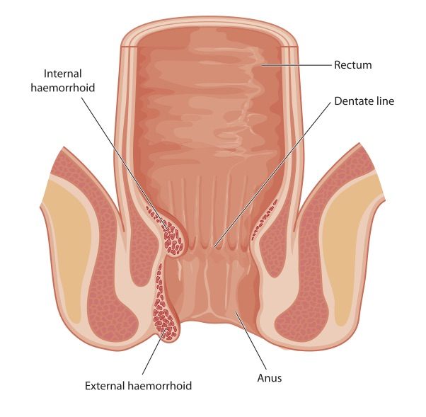 Haemorrhoid Haemorrhoid