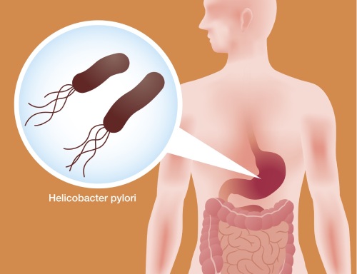 Helicobacter Pylori