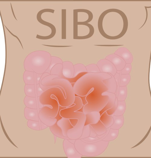 SIBO